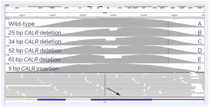 Figure 4: Detection of insertions and deletions in exon 9 of CALR