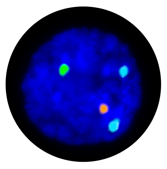Fluorescence in situ hybridisation (FISH) interphase result for the X, Y and 18 centromere prenatal FISH probe.