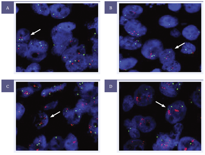 Figure 3: HER2 Analyte Control tested using the CytoCell HER2 amplification probe (LPS 001-A) with Chromosome 17 centromere (LPE 017G).