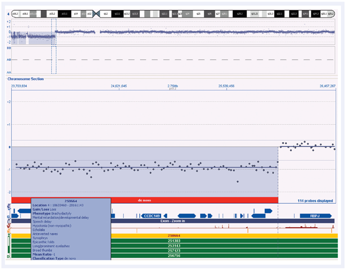 Figure 5: CytoSure Interpret Software in conjunction with the high-quality data obtained using CytoSure arrays and labelling kits allows accurate detection of chromosomal abnormalities
