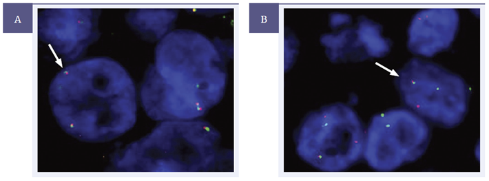 Figure 4. ROS1 Analyte Control slide was tested using the CytoCell ROS1-GOPC proximal and distal probes (LPH 0511-A/LPS 0510-A).