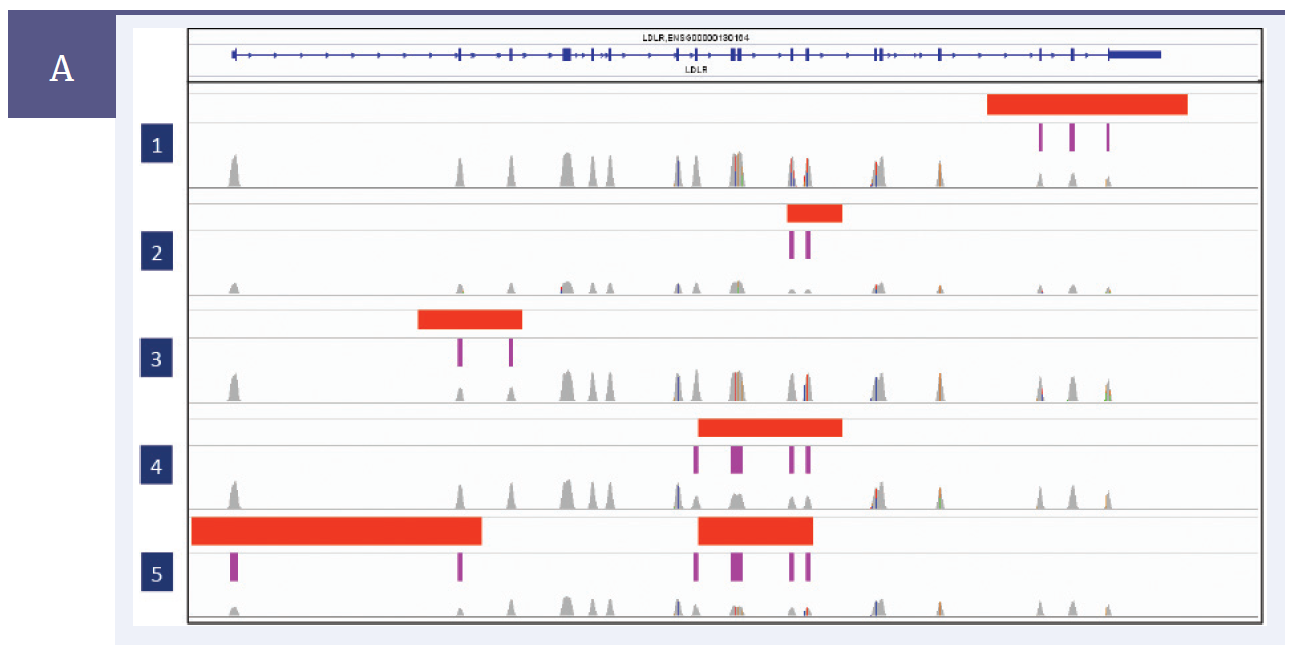 Figure 1a: Red bars indicate areas of CNV (data from aCGH), purple bars represent deleted exons (data from NGS): 5 samples are shown, each with at least one area of CNV. There is complete concordance between the aCGH and NGS data. Note the evenness of the NGS coverage (even peak height) across each exon, allowing the areas of CNV to be easily identified. The data from the custom CytoSure aCGH array, confirms the deletions in LDLR.