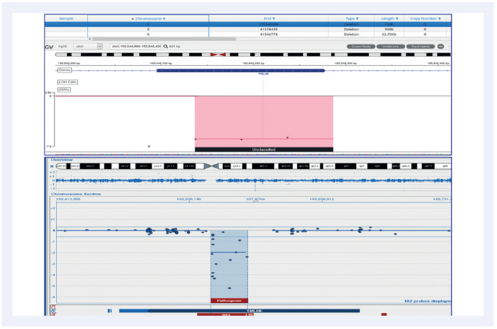 Figure 6: A 150b intragenic deletion on chromosome X.