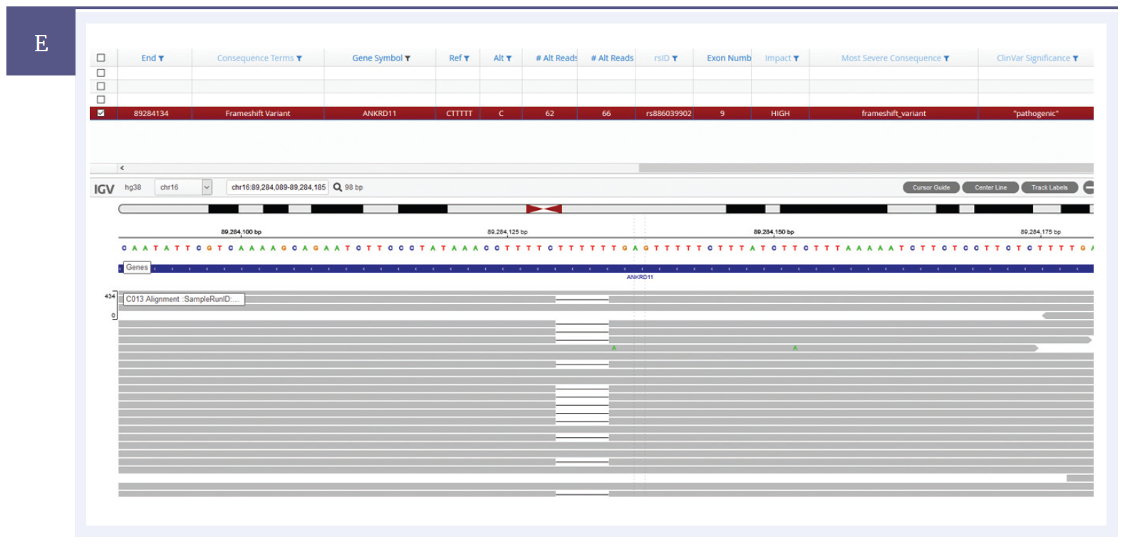 Figure 1e: Sample showing an indel. A c.2408_2412del (p.Lys803Argfs*5) indel detected within the ANKRD11 gene.*