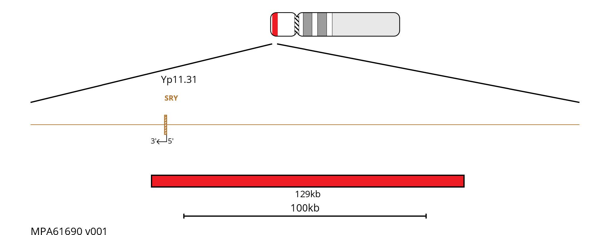Fluorescence in situ hybridisation (FISH) chromosome map showing a 129kb red probe targeting the SRY gene on chromosome Y.