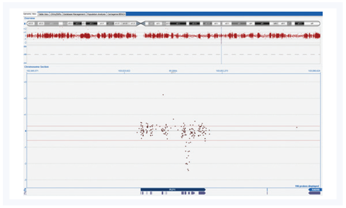 Figure 4: Detection of an aberration within the PLP1 gene using the CytoSure Medical Research Exome array scanned with the InnoScan 710 scanner