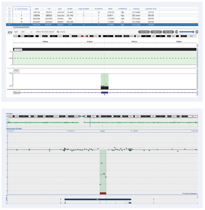 50bp deletion in Androgen Receptor gene on chromosome X