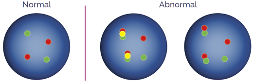 Translocation, dual fusion probes