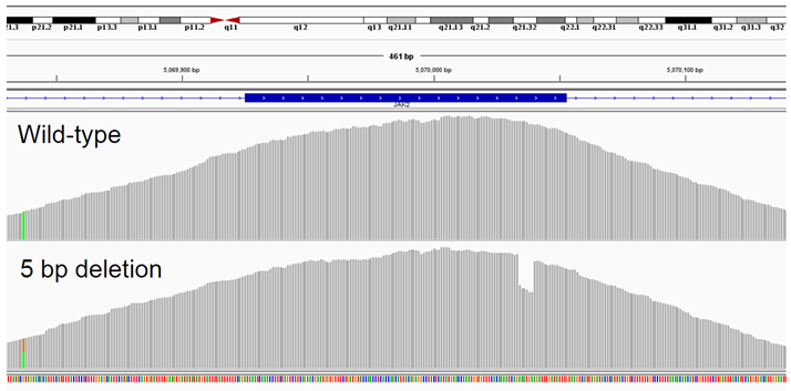 Figure 3: Detection of a 5 bp deletion (exon 12 JAK2).