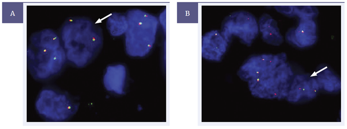 Figure 5. ALK-Lung Analyte Control tested using the CytoCell ALK breakapart probe (LPS 019-A).