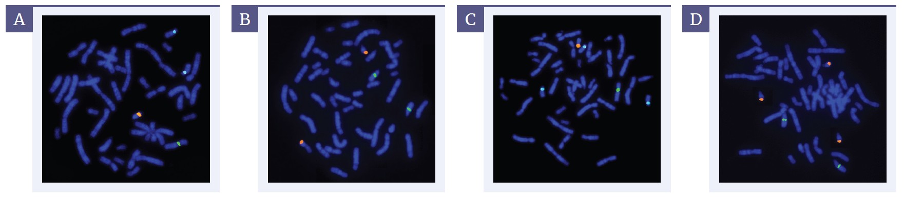 <b>Figure 1:</b> Representative fluorescence microscopy images generated using CE-LPF 001. <b>[A]</b> Normal male sample demonstrating one chromosome X signal (green), one chromosome Y signal (orange), and two chromosomes 18 signals (aqua). <b>[B]</b> Normal sample demonstrating two chromosome 13 signals (green) and two chromosome 21 signals (orange). <b>[C]</b> Abnormal male sample demonstrating one chromosome X signal (green), one chromosome Y signal (orange), and trisomy 18 (three aqua signals), consistent with Edwards syndrome. <b>[D]</b> Abnormal sample demonstrating two chromosome 13 signals (green) and trisomy 21 (three orange signals), consistent with Down syndrome.