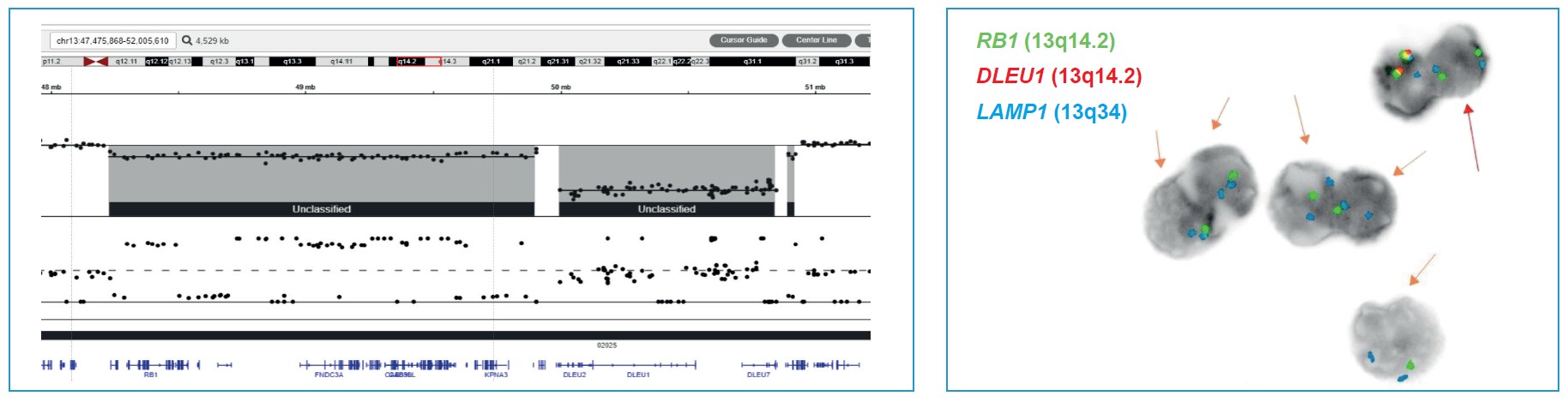 <b>Figure 1b:</b> OGT’s Interpret NGS Analysis Software visualisation and FISH result of a compound rearrangement resulting from biclonal 13q deletion (sample 1262). The major clone (83% of cells) harboured sole <i>DLEU1</i> deletion, the minor clone (12% of cells) both – <i>DLEU1</i> and <i>RB1</i> deletions.