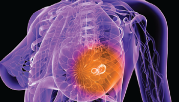 Breast Cancer