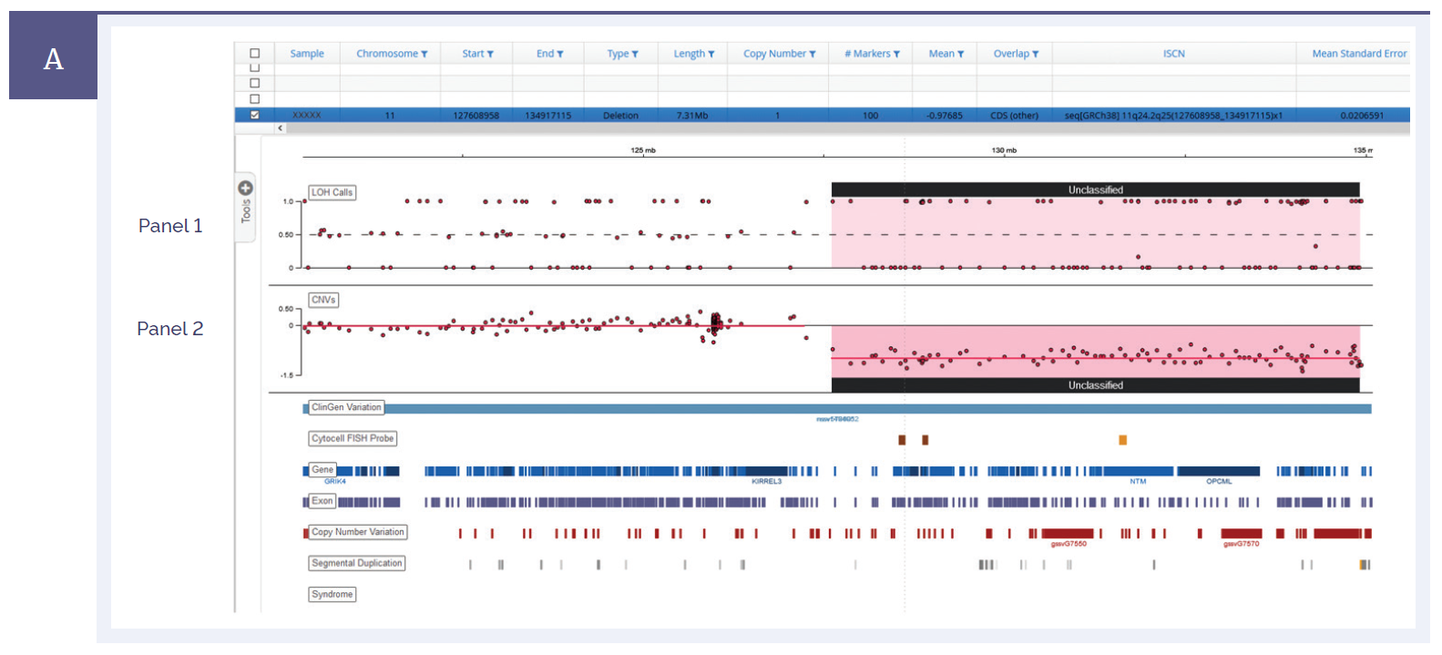 Figure 1a: A 7.3 Mb deletion detected on chromosome 11. Panel I shows the B allele frequency or LOH, whilst panel II shows the copy number ratio change*.
