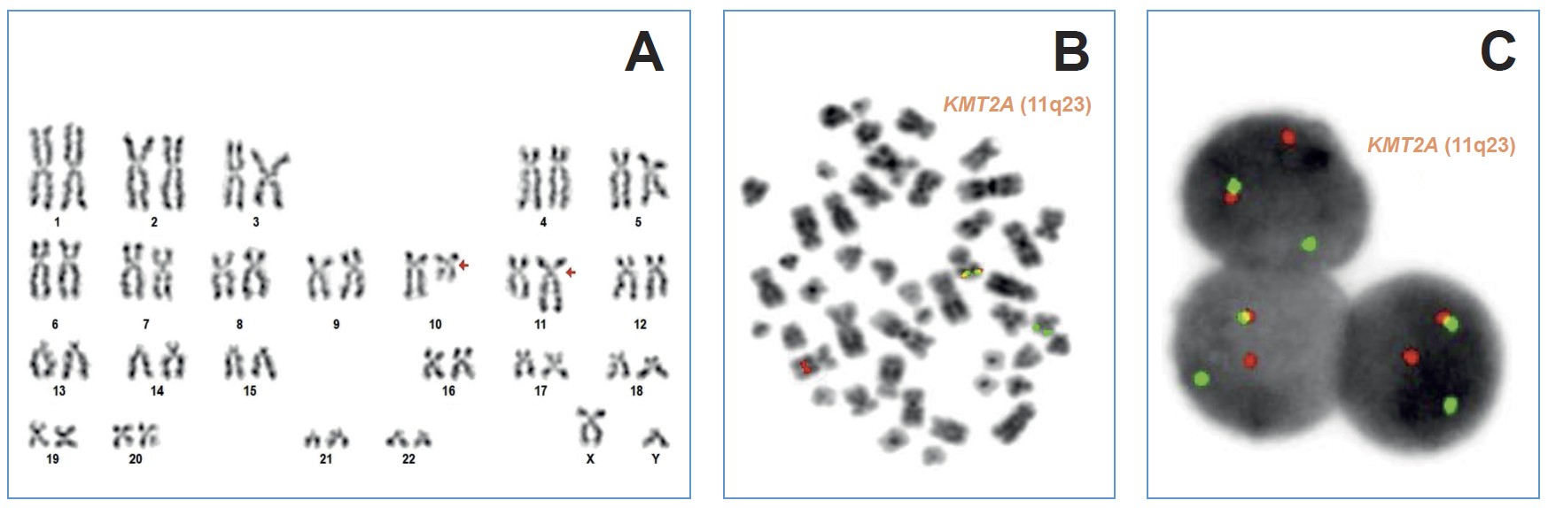 <b>Figure 2:</b> Unknown <i>KMT2A</i> rearrangement, described initially as 46,XY,t(10;11)(q22;q23) with <i>KMT2A::MLLT10</i> rearrangement GTG <b>(A)</b>, ISH <b>(B)</b> and nucISH<b>(C)</b>.