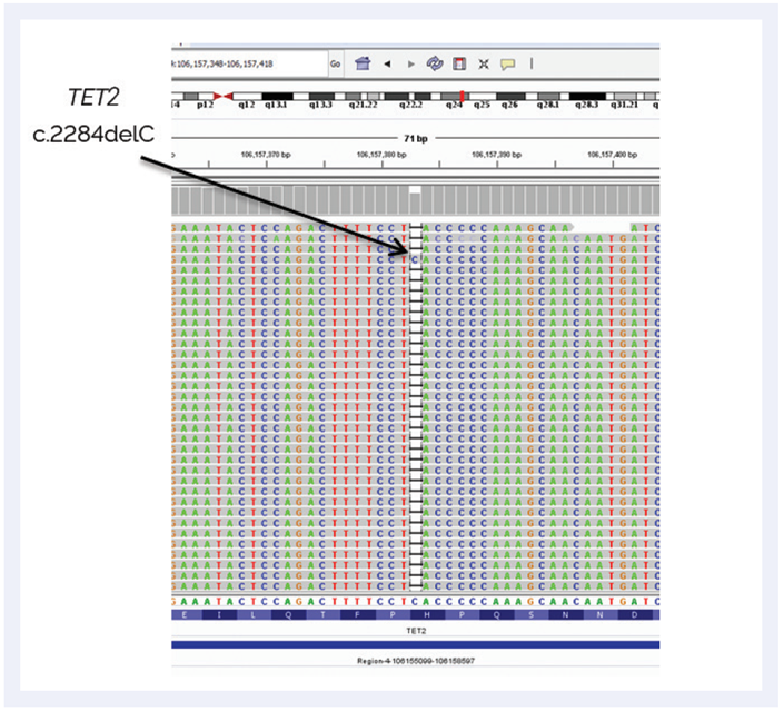 Figure 2: NGS analysis showing the TET2 mutation