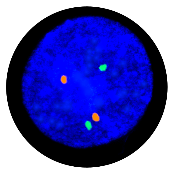 Fluorescence in situ hybridisation (FISH) interphase result for the 13q14.2 and 21q22.13 prenatal FISH probe.